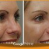 Botox for Hooded Eyes