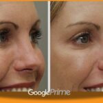 Botox for Hooded Eyes
