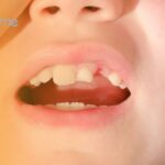 What is tooth decay in children