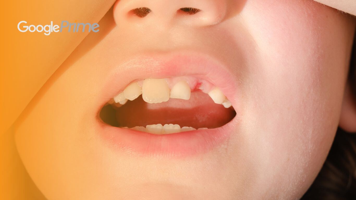 What is tooth decay in children